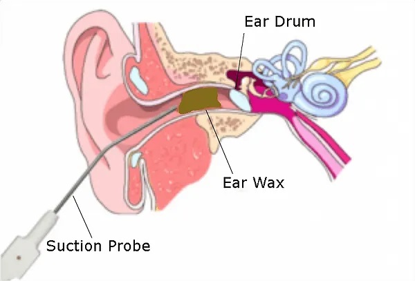 ear wax removal